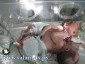 وفاة التوأمين الفلسطينيين بعد تدهور حالتهما في الرياض