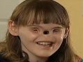 شاهد الفيديو : فتاة أميركية بدون أنف وعينين تتحضر لجراحة نادرة