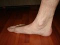 القدم المسطحة عامل مُسبب لآلام أسفل الظهر