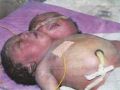 ولادة طفلة برأسين في السودان - صوره