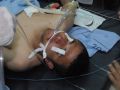 اصابة الشاب حمزه حالوب بجروح خطيره برصاص الاحتلال غرب طولكرم - شاهد الصور والفيديو