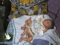 ولادة طفل باكستاني بـ 6 أرجل