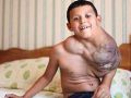 الفياغرا لعلاج طفل من ورم ضخم في رقبته