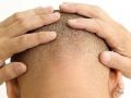 تقنية جديدة لزرع الشعر ومكافحة الصلع