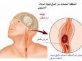 السكتة الدماغية تصيب واحدا من كل 6 اشخاص في العالم فماذا تعرف عنها