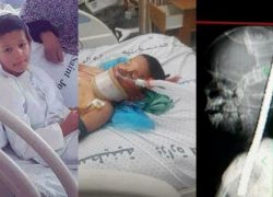 تفاصيل قصة الطفل الذي اخترق قضيب حديد رأسه دون أن يقتله في غزة