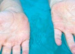 لماذا تتجعد أصابعنا بعد تعرضها للمياه؟