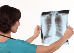 السل .. السبب الرئيسي للوفاة في العالم بدل الإيدز