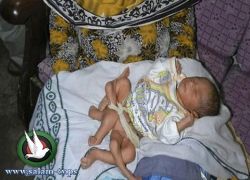 ولادة طفل باكستاني بـ 6 أرجل