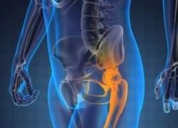 الحقول مغناطيسية لعلاج أمراض المفاصل