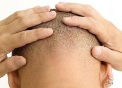 تقنية جديدة لزرع الشعر ومكافحة الصلع
