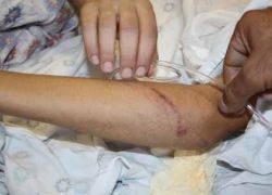 إصابة فتى مقدسي بعد رشه بالغاز من قبل مستوطن