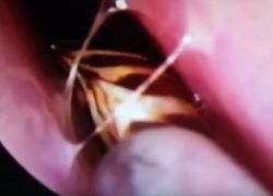 عانت من صداع فأخرج الأطباء صرصورا "حيا" من رأسها
